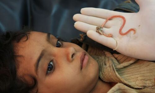 बच्चे के पेट में हुए ऐसे कीड़े कि पी गए उसका सारा खून