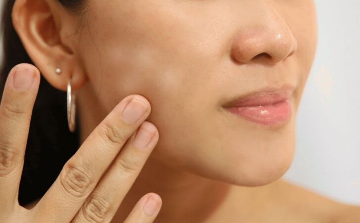 चेहरे के सफ़ेद दागों को इन तरीकों से कर सकते हैं दूर