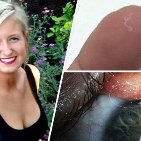 लड़की की आँख से निकले जानवरों वाले कीड़े