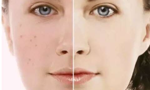 खीरे से दूर कर सकते हैं चेहरे के कील मुंहासे