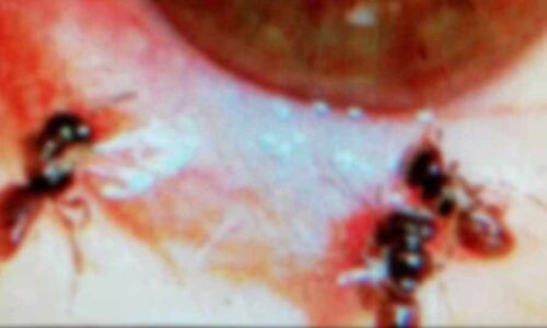 ताइवान में महिला की आंख के अंदर मिलीं 4 जिंदा मधुमक्खियां, डॉक्टर भी हुए हैरान