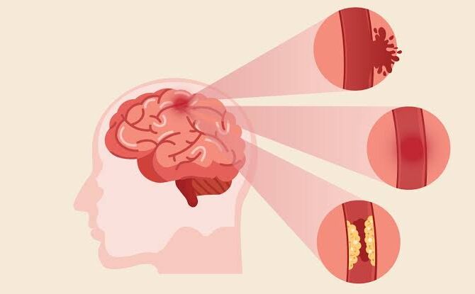 ठंड के दिनों में इन लोगों को बढ़ जाता है ब्रेन स्ट्रोक का खतरा, ऐसे करें बचाव