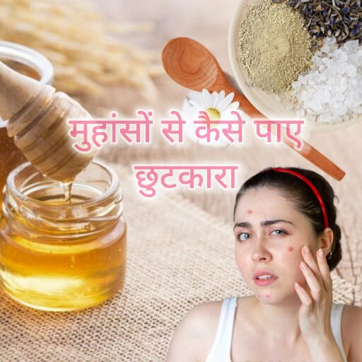 मुँहासे, सुंदरता में दाग और उनसे छुटकारा पाने के उपाय मुँहासे, सुंदरता में दाग और उनसे छुटकारा पाने के उपाय