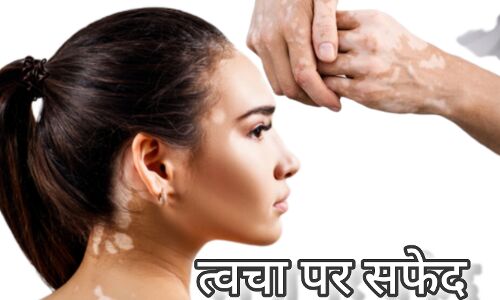 त्वचा पर सफेद चक्कते के कारण, लक्षण और घरेलू उपचार