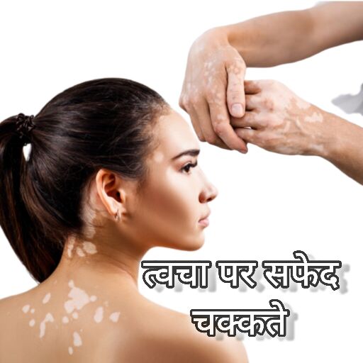 त्वचा पर सफेद चक्कते के कारण, लक्षण और घरेलू उपचार त्वचा पर सफेद चक्कते के कारण, लक्षण और घरेलू उपचार