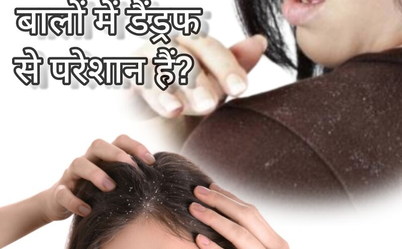 बालों में डैंड्रफ, कारण, लक्षण और घरेलू उपाय बालों में डैंड्रफ, कारण, लक्षण और घरेलू उपाय