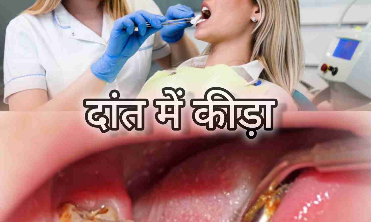 दांत में कीड़ा लग जाए तो क्या करें?