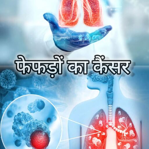 फेफड़ों का कैंसर: क्या है, कारण, लक्षण और बचाव