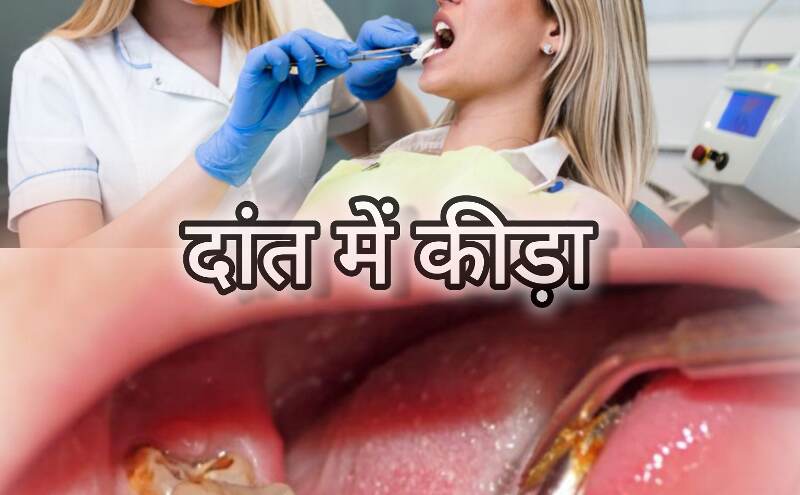 दांत में कीड़ा लग जाए तो क्या करें? दांत में कीड़ा लग जाए तो क्या करें?