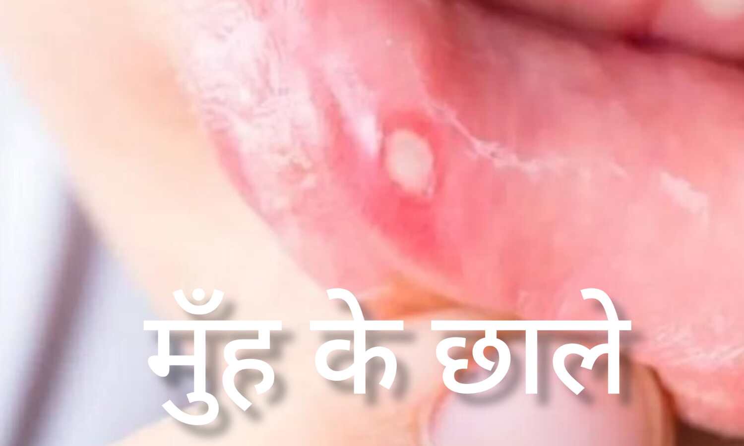 मुंह के छालों से परेशान? अपनाएं ये घरेलू उपाय