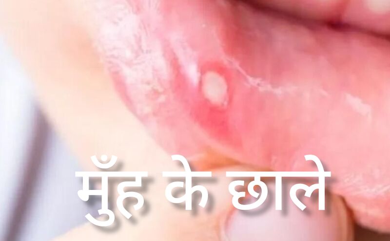 मुंह के छालों से परेशान? अपनाएं ये घरेलू उपाय मुंह के छालों से परेशान? अपनाएं ये घरेलू उपाय