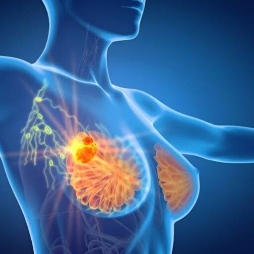 स्तन कैंसर की घर पर जांच कैसे करें