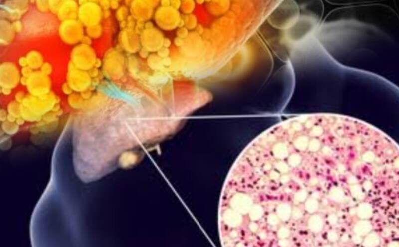 फैटी लीवर में क्या खाएं, क्या ना खाएं?