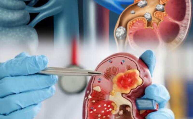क्यो होता है किडनी स्टोन, रोकथाम और उपचार संभव