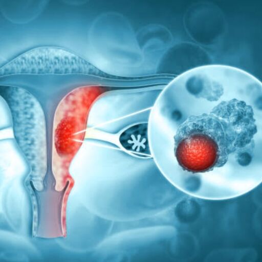 ओवेरियन कैंसर कैसे हैं महिलाओं के लिए खतरा