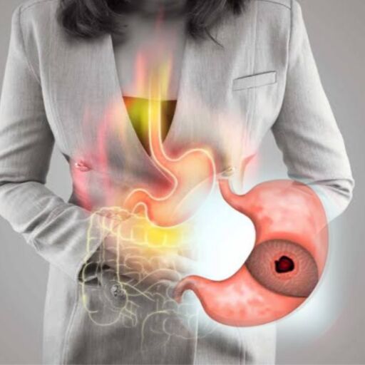 पेट का अल्सर, जानिए इसके लक्षण, कारण और बचाव पेट का अल्सर, जानिए इसके लक्षण, कारण और बचाव