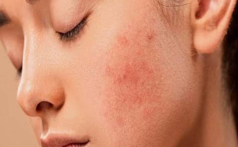 गर्मियों में मुंहासे, कारण और उपचार