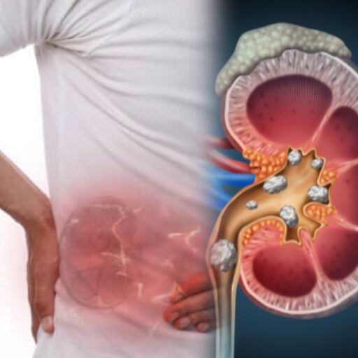 पथरी से बचाव: क्या खाएं, क्या नहीं और क्या ध्यान रखें पथरी से बचाव: क्या खाएं, क्या नहीं और क्या ध्यान रखें