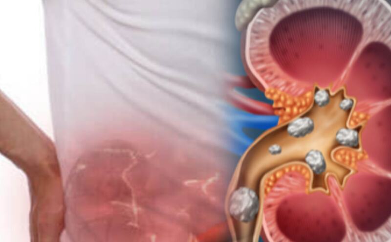 पथरी से बचाव: क्या खाएं, क्या नहीं और क्या ध्यान रखें