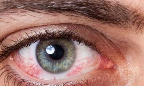 लू से बढ़ रहा है आई स्ट्रोक का खतरा, जानिए क्या है और कैसे बचें?