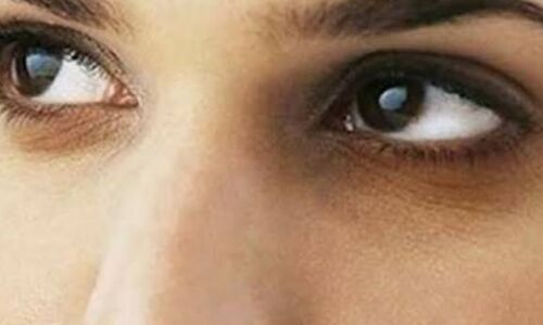 आंखों के नीचे काले घेरे, कारण और उपाय