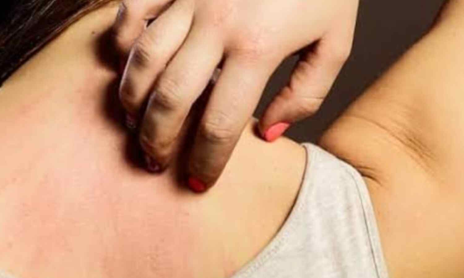 गर्मी में घमौरियों से राहत पाने के घरेलू उपाय