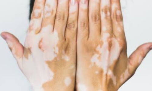 विश्व विटिलिगो दिवस, मिथक तोड़ते हुए, जागरूकता बढ़ाते हुए विश्व विटिलिगो दिवस, मिथक तोड़ते हुए, जागरूकता बढ़ाते हुए