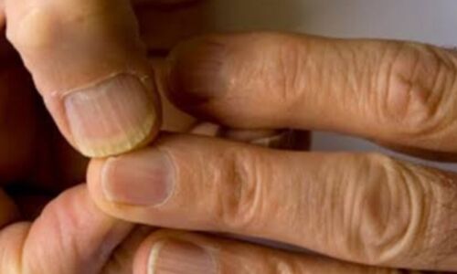 नाखूनों पर भूरे धब्बे, खूबसूरती का दाग या सेहत का संकेत? नाखूनों पर भूरे धब्बे, खूबसूरती का दाग या सेहत का संकेत?