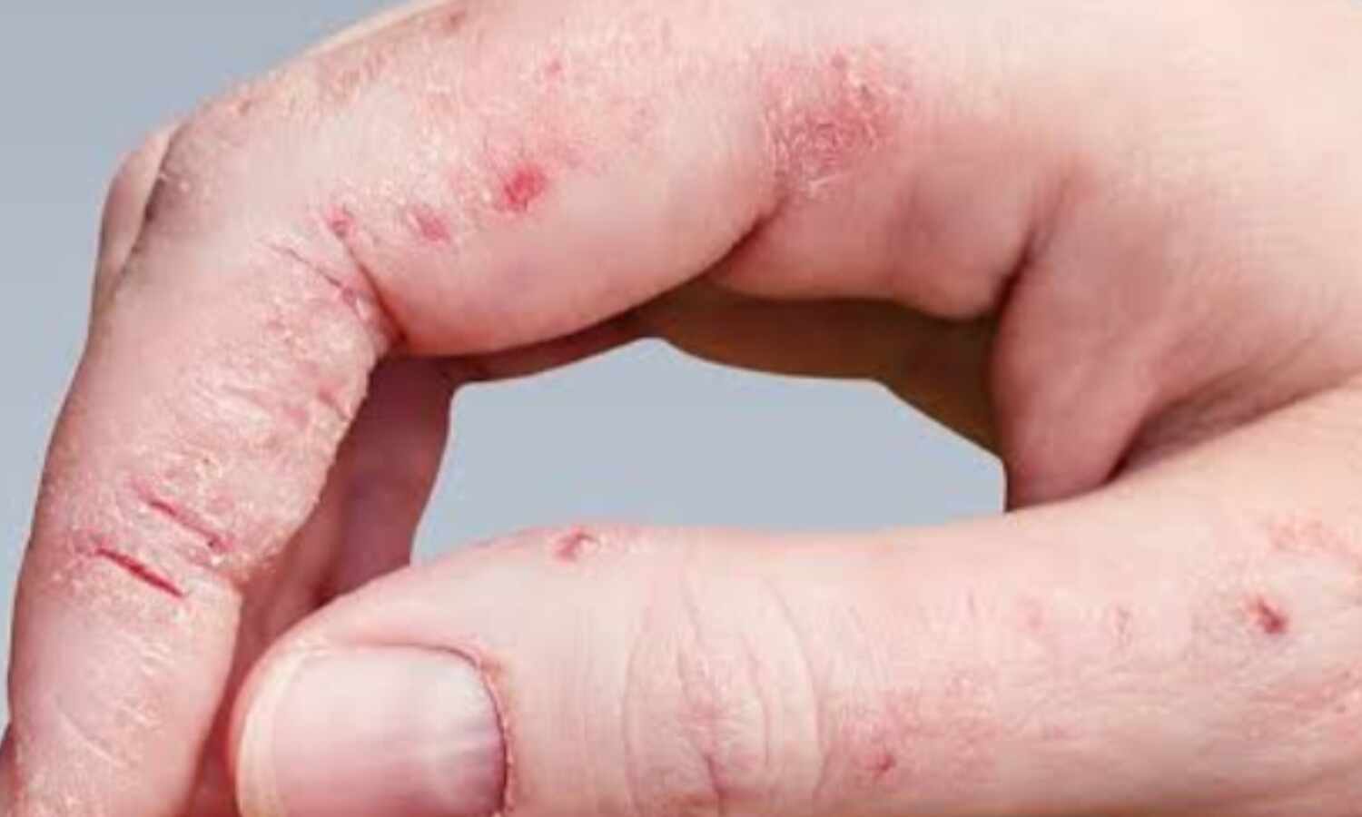 मानसून में फंगल इंफेक्शन से बचाव, टिप्स और जानकारी