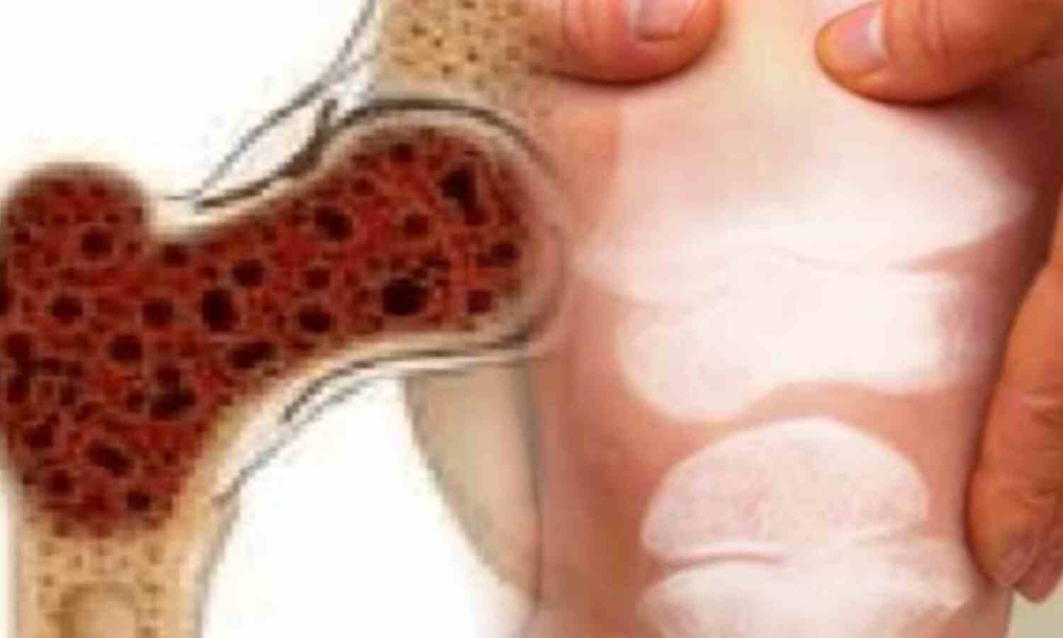 हड्डी का कैंसर (बोन कैंसर) लक्षण और इलाज