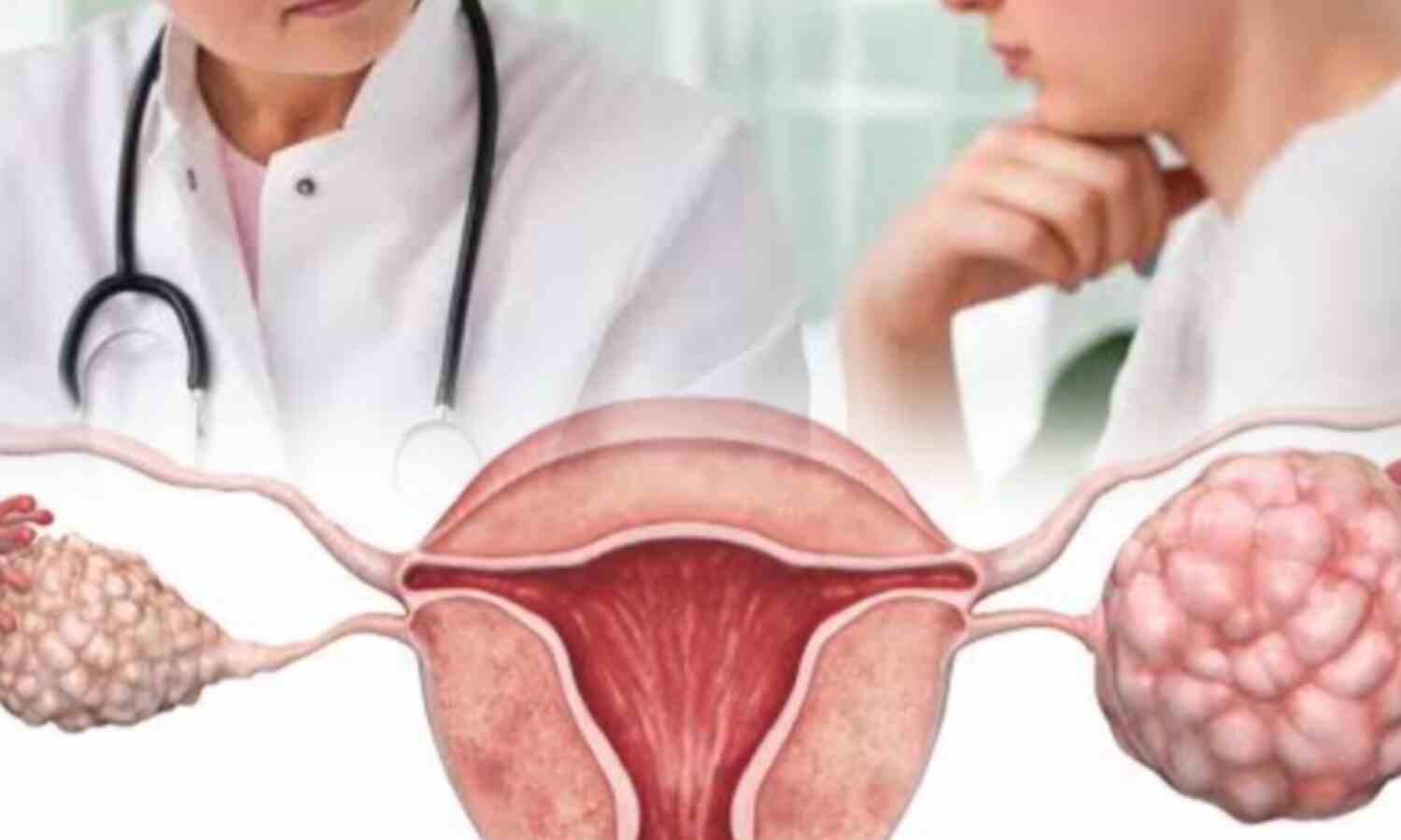ओवेरियन सिस्ट (Ovarian Cyst), लक्षण और उपचार