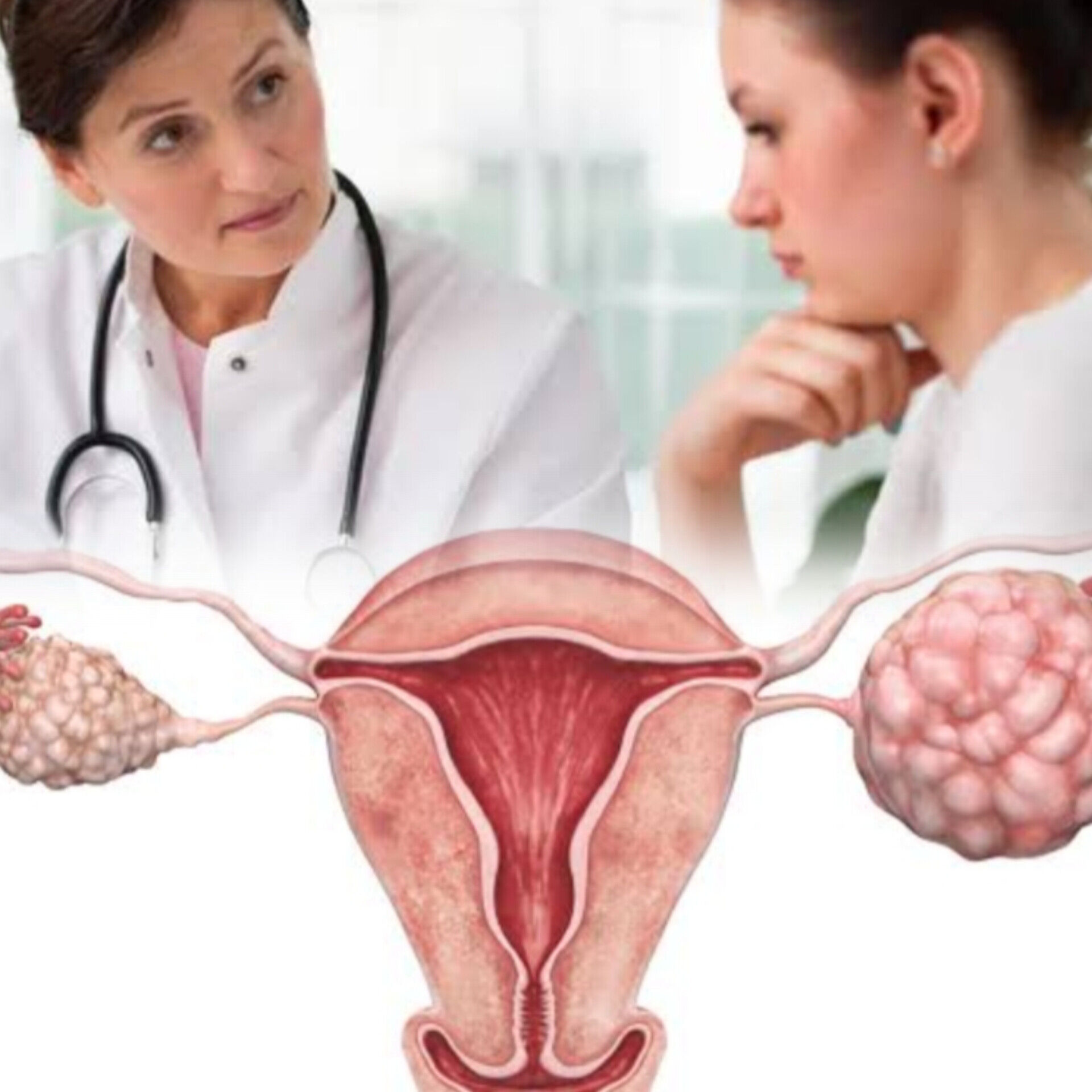 ओवेरियन सिस्ट (Ovarian Cyst), लक्षण और उपचार