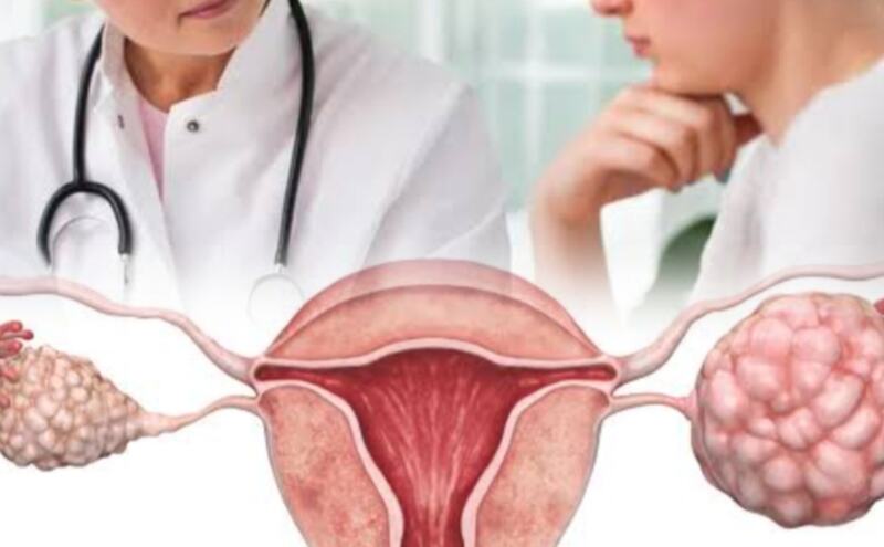ओवेरियन सिस्ट (Ovarian Cyst), लक्षण और उपचार ओवेरियन सिस्ट (Ovarian Cyst), लक्षण और उपचार