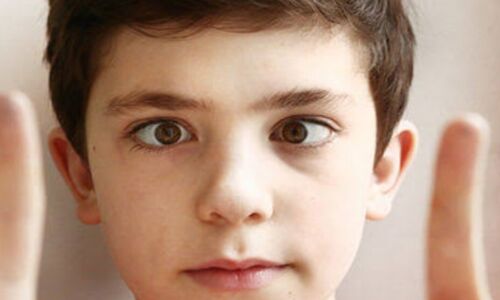 आंखों में भेंगापन (Squint) एक आम समस्या, लक्षणों को पहचानें और जल्द करें इलाज