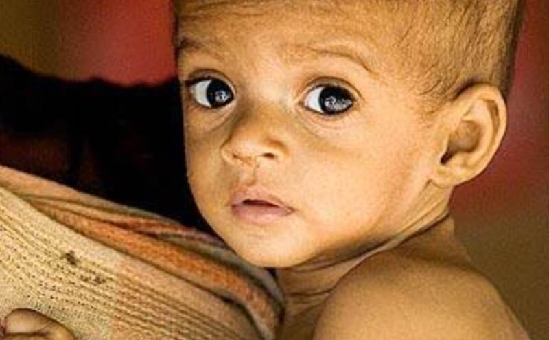 दुनिया में बढ़ता कुपोषण का संकट दुनिया में बढ़ता कुपोषण का संकट