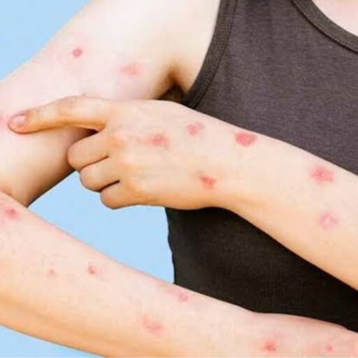 मंकीपॉक्स का खतरा भारत के दरवाजे पर भी