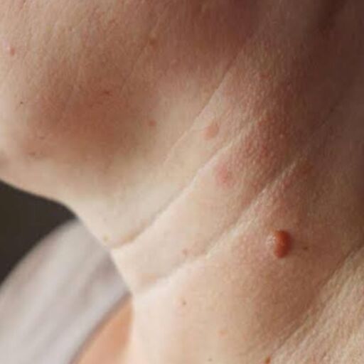 गर्दन पर काली धारी और मस्से, एक गंभीर संकेत