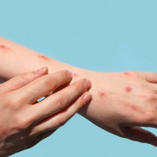 एमपॉक्स का खतरा पाकिस्तान में मामलों में इजाफा, भारत में बढ़ी चिंता