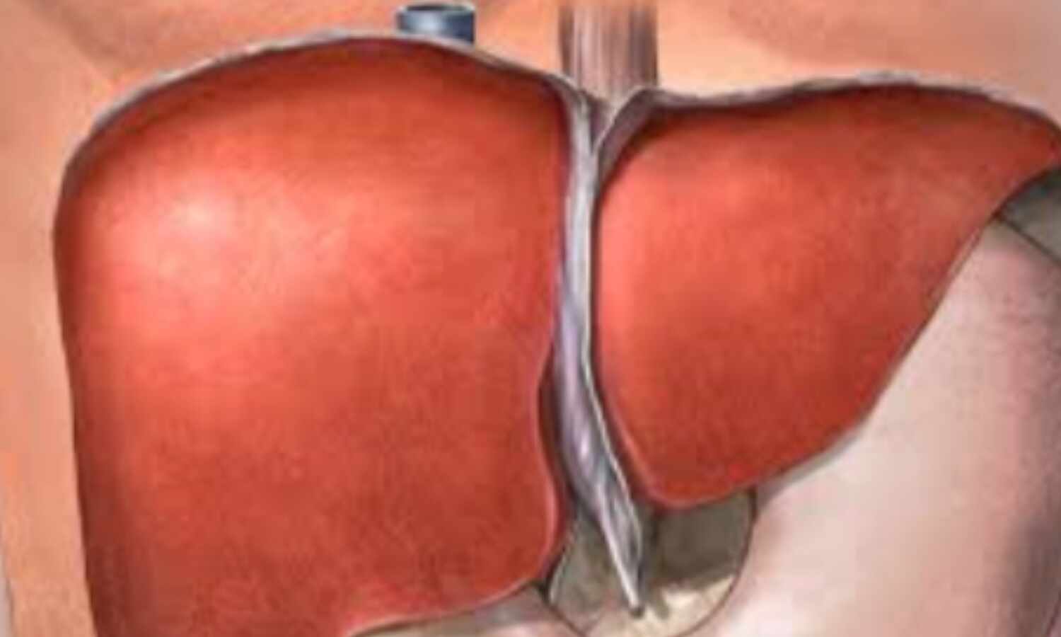हेपेटाइटिस ए का बरसात में बढ़ता खतरा, लिवर को बचाने के 3 तरीके