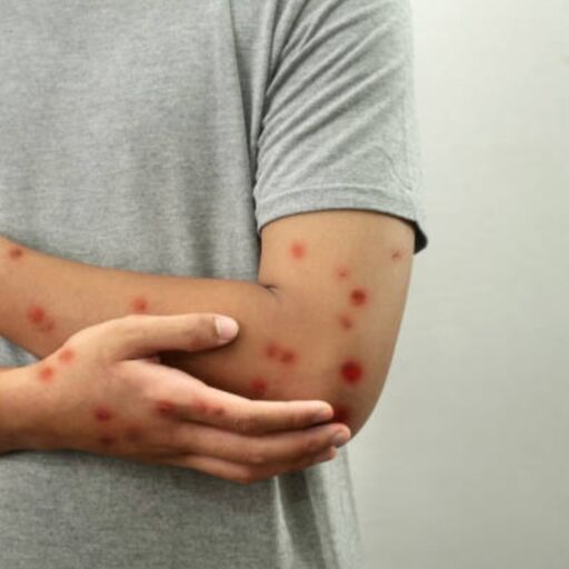 मंकीपॉक्स के बढ़ते खतरे से सावधान रहें, अपनाएं ये प्राकृतिक उपाय