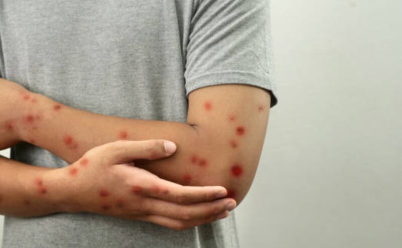 मंकीपॉक्स के बढ़ते खतरे से सावधान रहें, अपनाएं ये प्राकृतिक उपाय