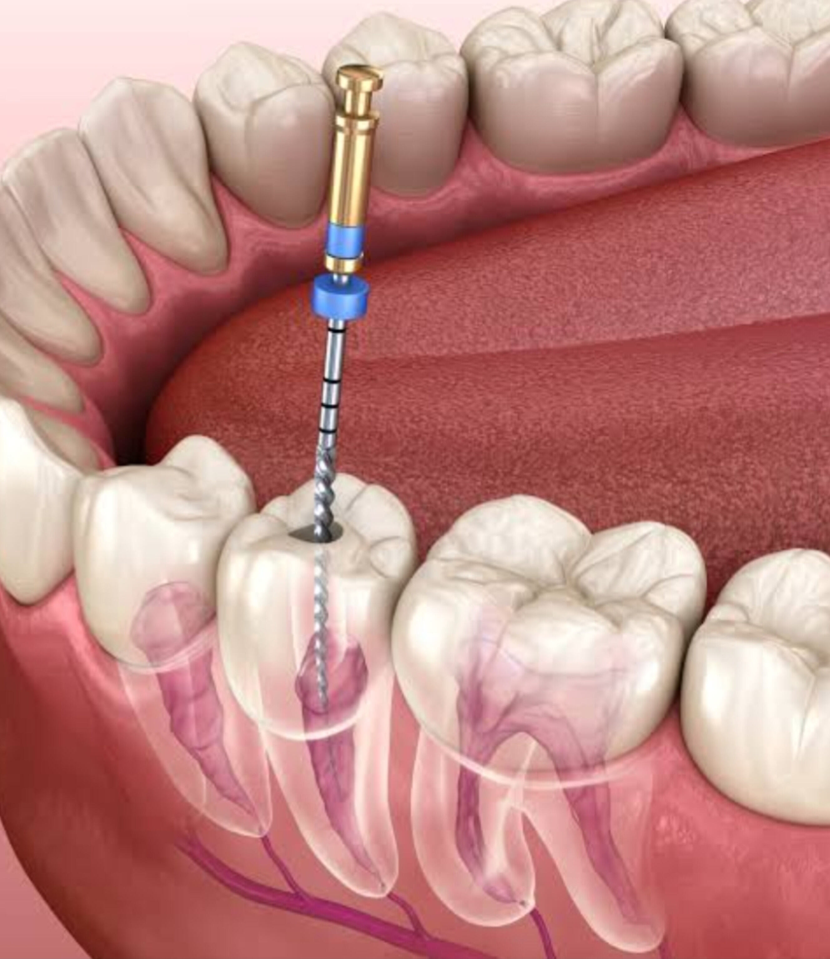 रूट कैनाल और हृदय का क्या है कनेक्शन? रूट कैनाल करवाने से पहले ये बातें जान लें