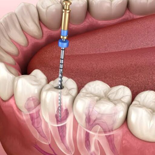 रूट कैनाल और हृदय का क्या है कनेक्शन? रूट कैनाल करवाने से पहले ये बातें जान लें रूट कैनाल और हृदय का क्या है कनेक्शन? रूट कैनाल करवाने से पहले ये बातें जान लें