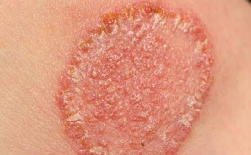 फंगल संक्रमण, एक चुपके से फैलती महामारी