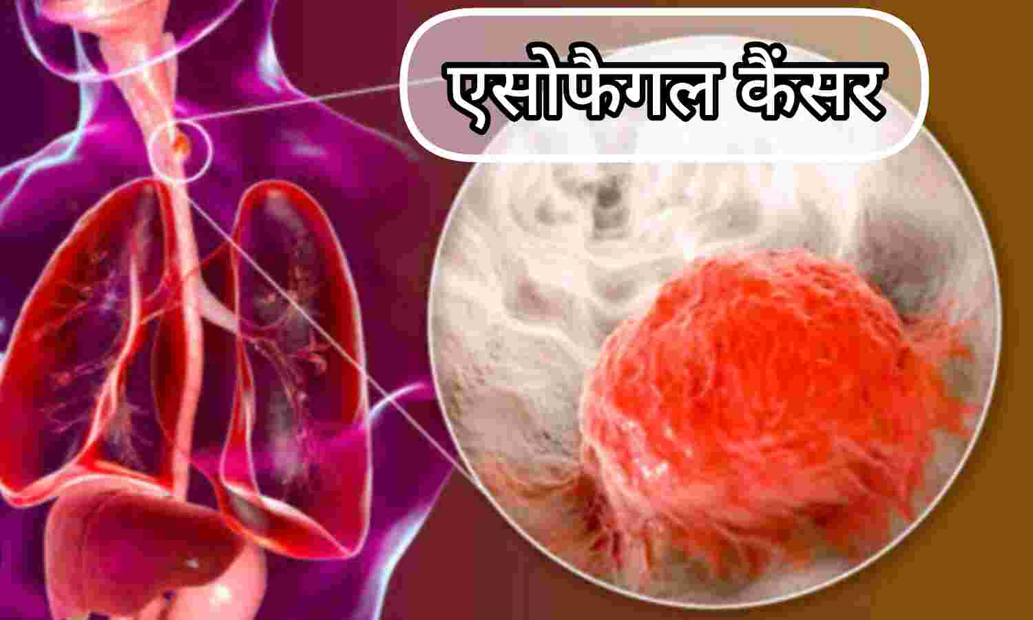एसोफैगल कैंसर के लक्षण, कारण और बचाव