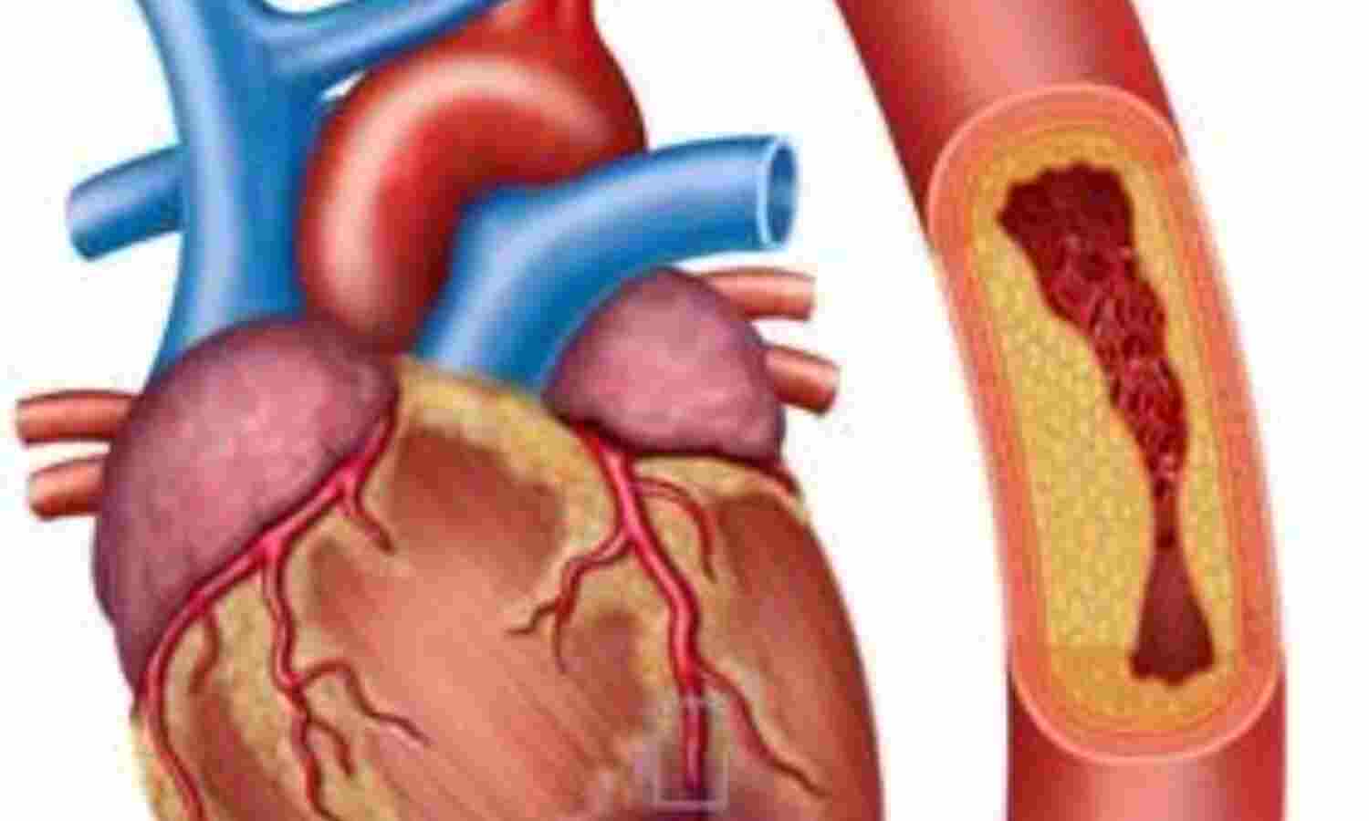 धमनियों में प्लाक (blockage), हार्ट अटैक का खामोश खतरा