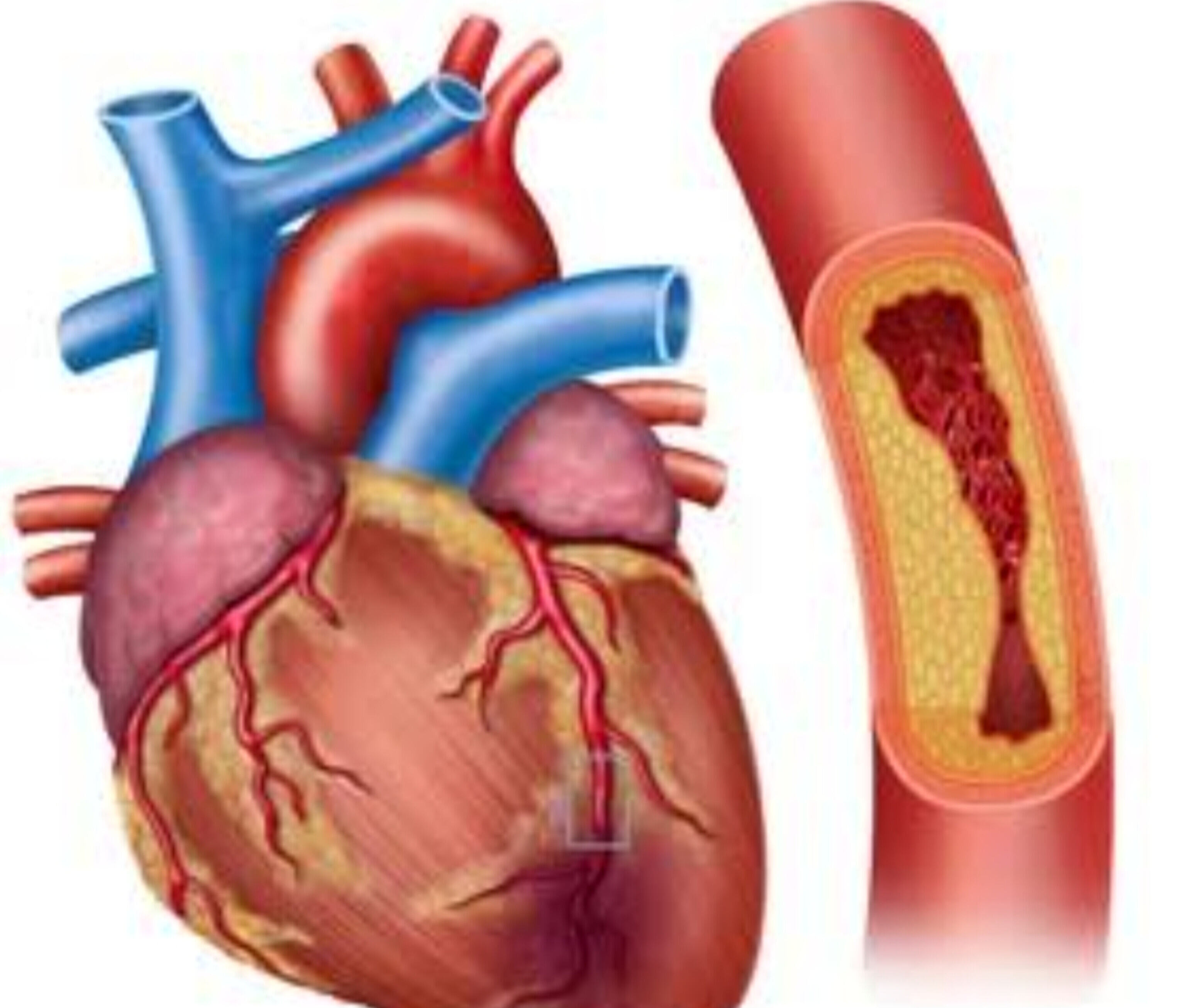 धमनियों में प्लाक (blockage), हार्ट अटैक का खामोश खतरा