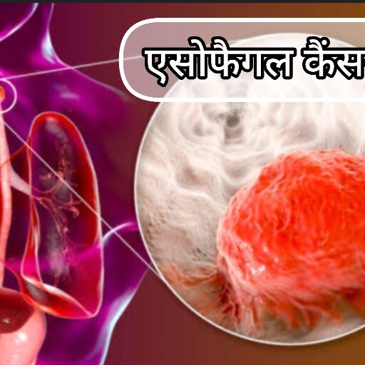 एसोफैगल कैंसर के लक्षण, कारण और बचाव एसोफैगल कैंसर के लक्षण, कारण और बचाव