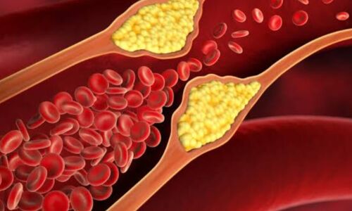 हाई कोलेस्ट्रॉल बढ़ाने वाले खाद्य पदार्थ, सावधान रहें!