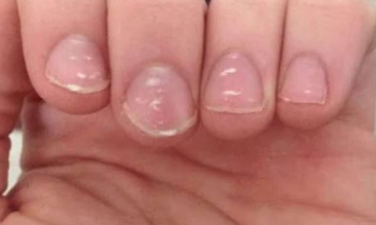 नाखूनों पर सफेद धब्बे, स्वास्थ्य के संकेत और कारण